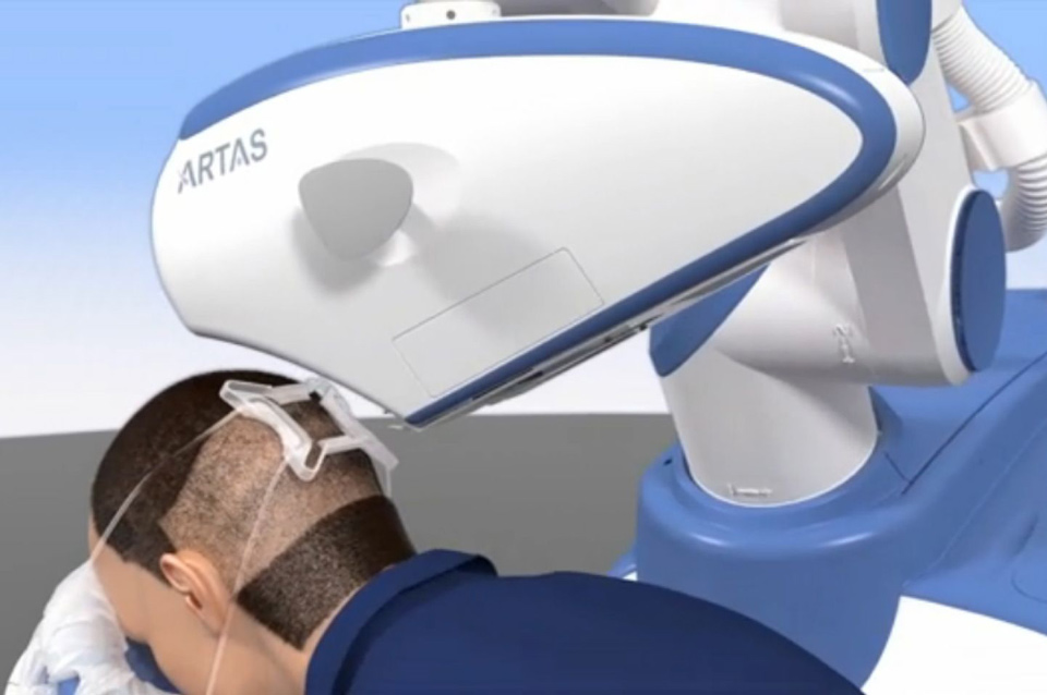 Роботизована система по трансплантації волосся ARTAS